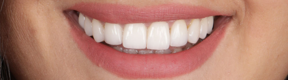 Kanal Tedavisi (Endodonti) Kanal Tedavisi (Endodonti)